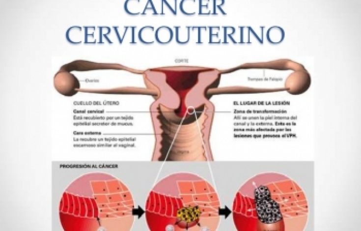 cancer